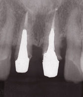 歯の根の治療2