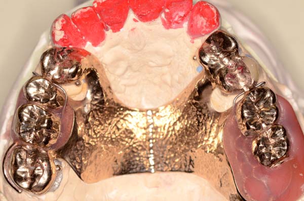 部分床義歯1