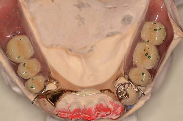 部分床義歯2