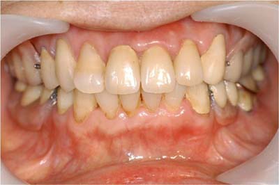 部分床義歯7