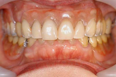 部分床義歯8