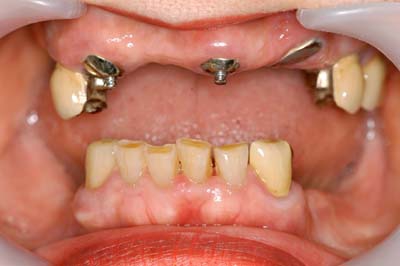 部分床義歯9