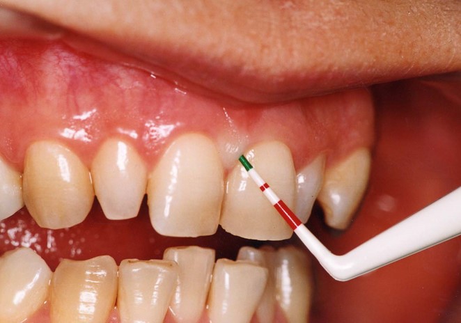 歯周病(歯槽膿漏)1
