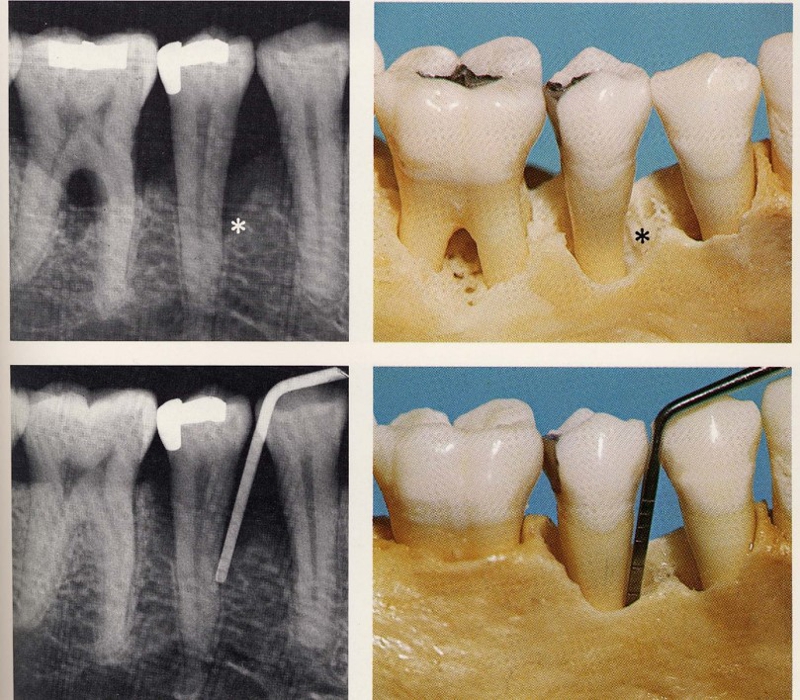 歯周病(歯槽膿漏)3