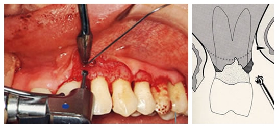歯周病(歯槽膿漏)4